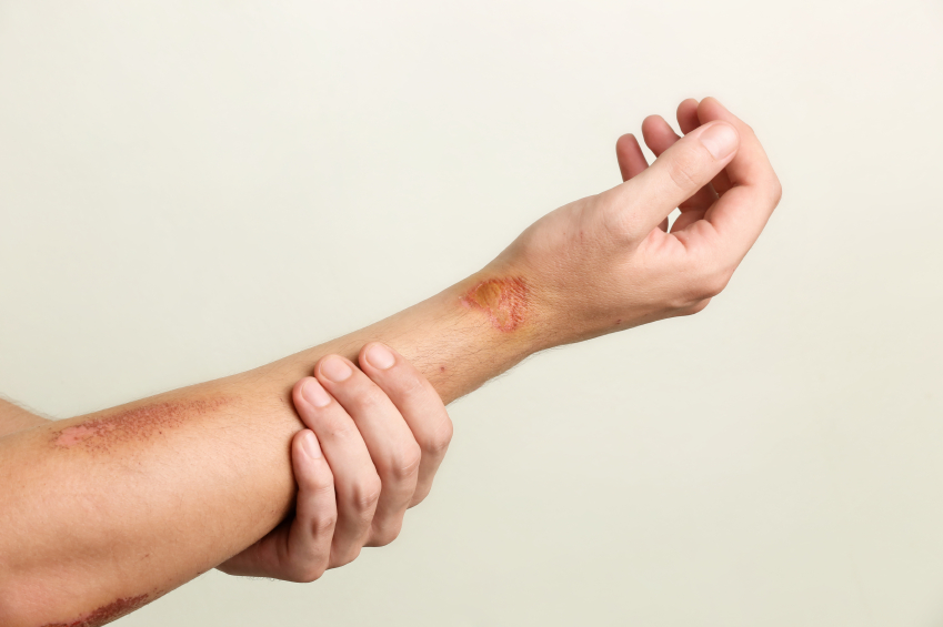 A picture of an arm with a painful looking burn on it
